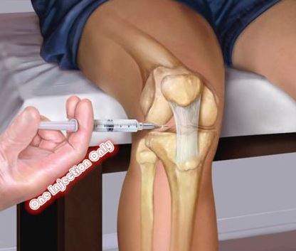 Hyaluronan Injections for Knee Osteoarthritis