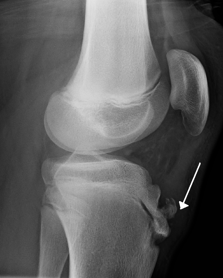 Radiograph of human knee with OsgoodSchlatter disease