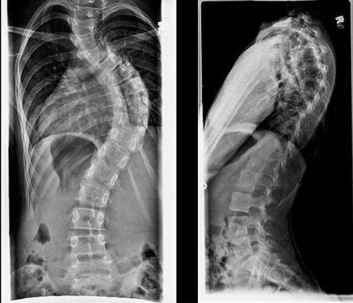 idiopathic scoliosis before x rays