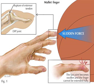 Wrist & Hand Injuries 1