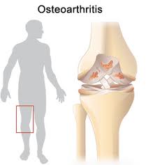 Οστεοαρθρίτιδα γόνατος 1