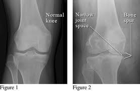 Knee Osteoarthritis 3