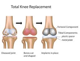 Knee Osteoarthritis 6