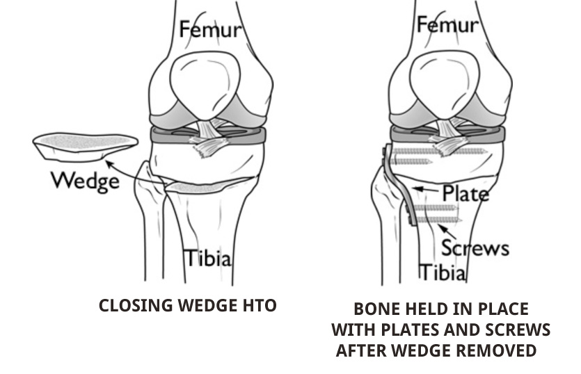 Knee Osteoarthritis 8
