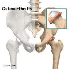Hip Osteoarthritis 1