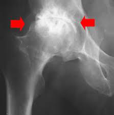 Hip Osteoarthritis 4