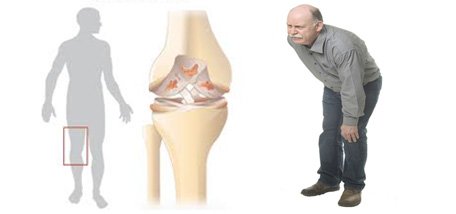 Knee Osteoarthritis 