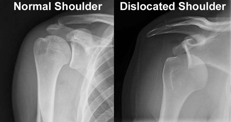 xray showing a comparison of normal versus dislocated shoulder
